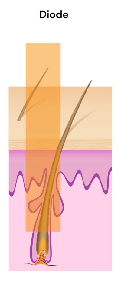 Akçay Lazer Epilasyon Merkezi edremit lazer, balıkesir lazer epilasyon