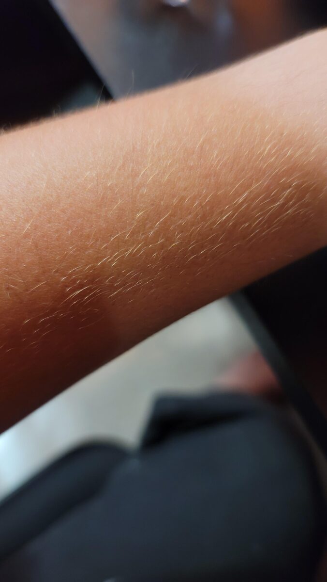 açık renk kıllar için lazer epilasyon